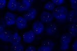 Fyziologický stav genu TOP2A vyšetřeného sondou LSI TOP2A (Orange) s centromrickou sondou CEP17 (Green) - parafinový řez nádorové tkáně