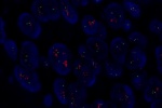 Amplifikace genu TOP2A vyšetřeného sondou LSI TOP2A (Orange) s centromerickou sondou CEP17 (Green) - parafinový řez nádorové tkáně