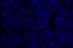 Fyziologický nález genu Her-2/neu vyšetřeného sondou LSI Her-2/neu (Orange) - parafinový řez nádorové tkáně