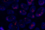 Amplifikace genu Her-2/neu vyšetřeného sondou LSI Her-2/neu (Orange) - parafinový řez nádorové tkáně