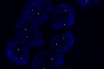 Translokace ALK EML4 vyeten fluorescenn prbou ALK (Orange)/ EML4 (Green) na parafinovm ezu tkn