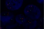 Fyziologický stav genů ALK a EML4 vyšetřených translokační sondou LSI ALK (Orange)/LSI EML4 (Green) na parafinovém řezu tkáně