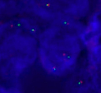 An abnormal cell hybridized with the LSI ROS1 translocation probe (Orange, Green). The cell in this image shows the one orange/green fusion signal, and one orange and one separate green signal, which indicate the ROS1 translocation.