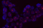 Amplifikace genu N-MYC vyšetřeného sondou LSI N-MYC (Orange) - parafínový řez