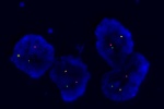 An abnormal cell hybridized with the LSI ALK (Orange) / LSI EML4 (Green) shows the one orange, one green and one orange/green fusion signal, which indicates the EML4-ALK inversion/translocation.