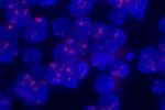 An abnormal cell in FFPE tissue hybridized with LSI EGFR (Orange) shows a higher copy number of EGFR gene.