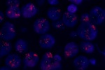 An abnormal cell in FFPE tissue hybridized with LSI RARA (Orange)/CEP17 (Green) shows a higher copy number of RARA gene and 2 green signals of chromosome 17.