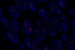 An abnormal cell in FFPE tissue hybridized with LSI TOP2A (Orange)/CEP17 (Green) shows a higher copy number of RARA gene and 2 green signals of chromosome 17.