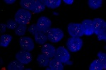 An abnormal cell in FFPE tissue hybridized with LSI Cyclin D1 (Orange)/CEP11 (Green) shows a higher copy number of Cyclin D1 gene and 2 green signals of chromosome 11.