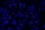 An abnormal cell in FFPE tissue hybridized with LSI C-MYC (Orange)/CEP8 (Green) shows a higher copy number of C-MYC gene and 2 green signals of chromosome 8.