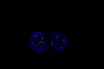 An abnormal cell in FFPE tissue hybridized with LSI Her-2/neu (Orange)/CEP17 (Green) shows the polyploidy of chromosome 17 and a higher copy number of Her2/neu gene (pseudo-amplification).