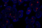 An abnormal cell in FFPE tissue hybridized with the LSI LSI Her-2/neu (Orange)/CEP17 (Green) shows 2 green signals of chromosome 17 and higher copy number of Her2/neu gene (amplification). 