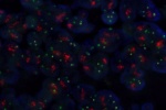 An abnormal cell in FFPE tissue hybridized with LSI EGFR (Orange)/CEP7 (Green) shows the polyploidy of chromosome 7 and a higher copy number of EGFR gene (pseudo-amplification).