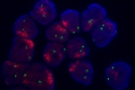 An abnormal cell in FFPE tissue hybridized with the LSI EGFR (Orange)/CEP7 (Green) shows 2 green signals of chromosome 7 and higher copy number of EGFR gene (amplification). 