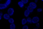 An abnormal cell hybridized with the LSI 10p11.1 (Orange) shows the one orange signal which indicates the loss of chromosome 10.