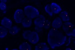 An abnormal cell hybridized with the LSI 19q13 (Orange) shows the one orange signal which indicates the loss of chromosome 19q13 region.