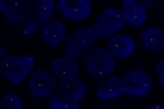 An abnormal cell hybridized with the LSI 1p36.3 (Orange) shows the one orange signal which indicates the loss of chromosome 1p36.3 region.