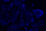 An abnormal cell hybridized with the LSI 9p21.3 (Orange) shows the one orange signal which indicates the loss of chromosome 9p21.3 region.