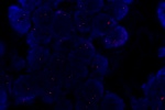 A normal cell hybridized with the LSI MDM2 (Orange) shows 2 orange signals of the MDM2 gene.