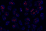 An abnormal cell hybridized with the LSI MDM2 (Orange) shows more than 20 orange signals which indicate the amplification of MDM2 gene.