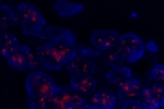 An abnormal cell hybridized with the LSI TOP2A (Orange) shows more than 20 orange signals which indicate the amplification of TOP2A gene.