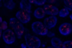 An abnormal cell hybridized with the LSI Cyclin D1 (Orange) shows more than 20 orange signals which indicate the amplification of Cyclin D1 gene.