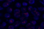 An abnormal cell hybridized with the LSI C-MYC (Orange) shows more than 20 orange signals which indicate the amplification of C-MYC gene.