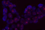 An abnormal cell hybridized with the LSI N-MYC (Orange) shows more than 20 orange signals which indicate the amplification of N-MYC gene.